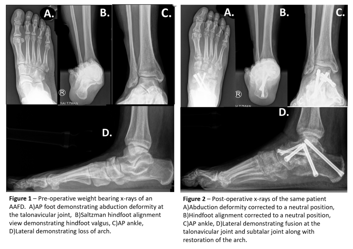 Posterial Tibial Tendency.PNG