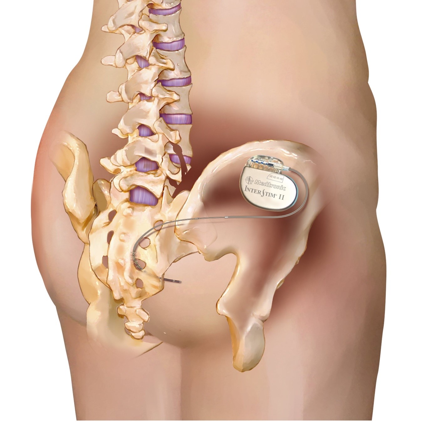 General Stim's implanted sacral nerve stimulation approved in